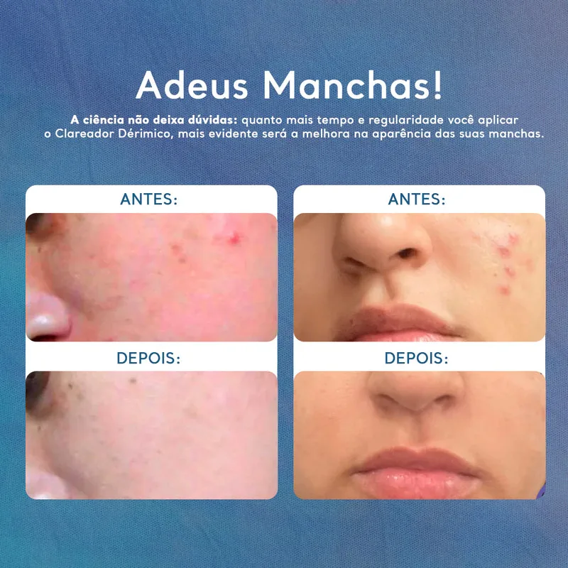 Cicatribem Clareador Dérmico 60g — Auxiliar para Manchas Localizadas