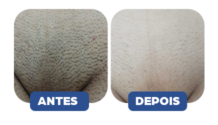 Antes e Depois 3