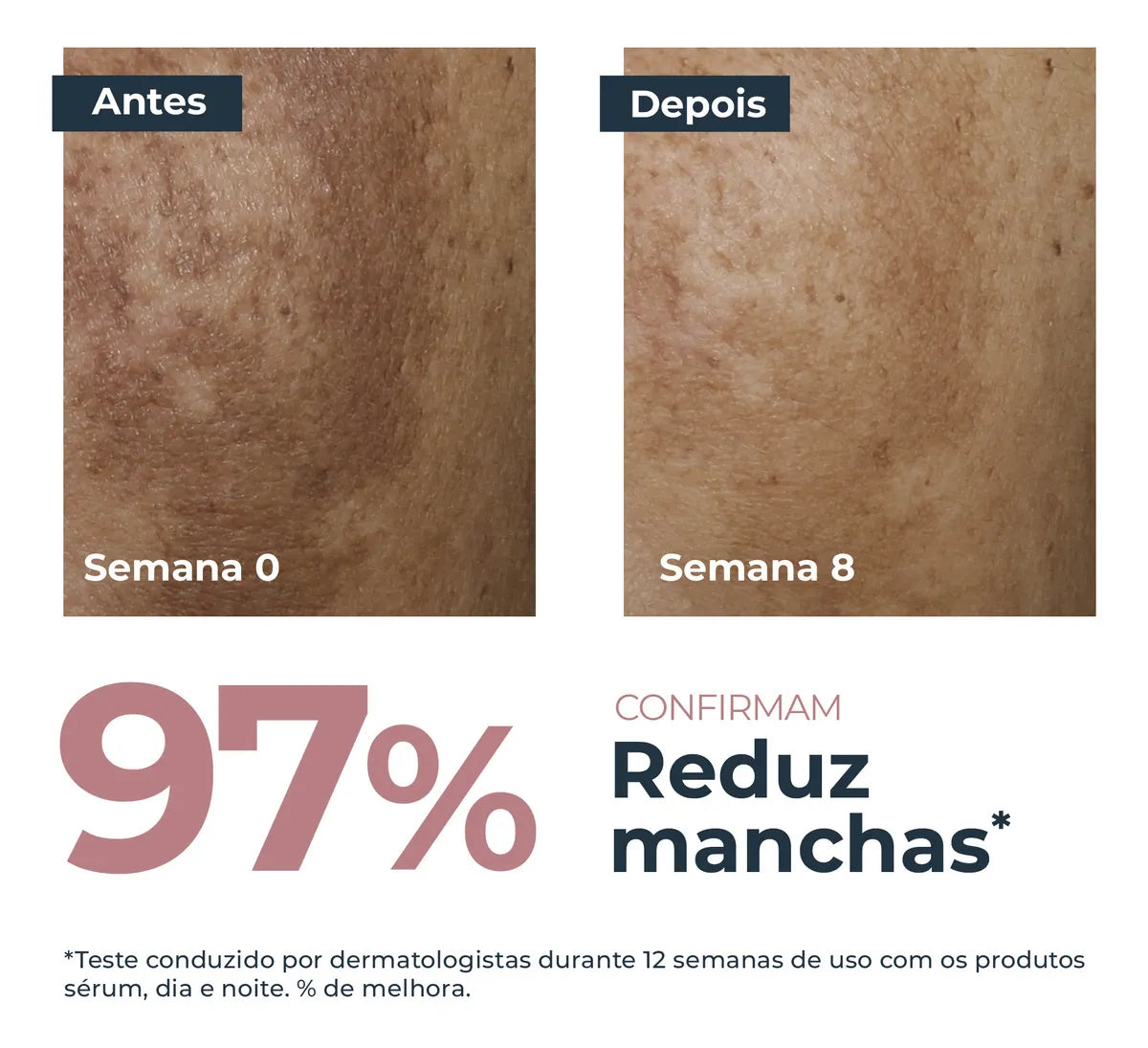 Antes e depois do tratamento com Eucerin Anti-Pigment