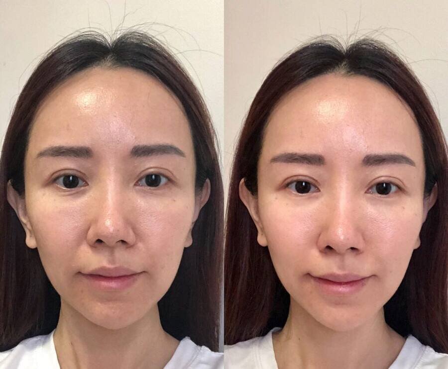 Marina S. — antes e depois