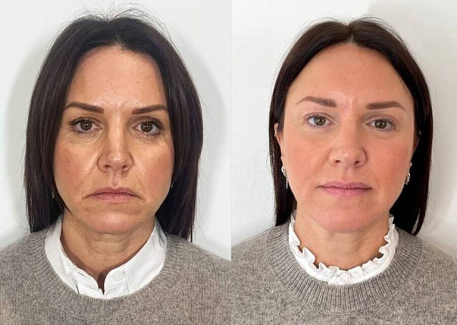 Antes Semana 0 e Depois Semana 12: rugas profundas suavizadas, contornos definidos, pele firme