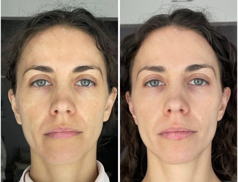 Resultado Beatriz A.